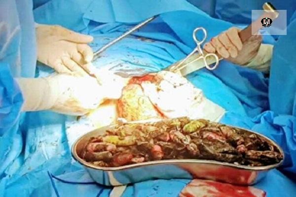 خروج ۹۰ بسته مواد مخدر از معده و روده بیماری در کرج&nbsp;